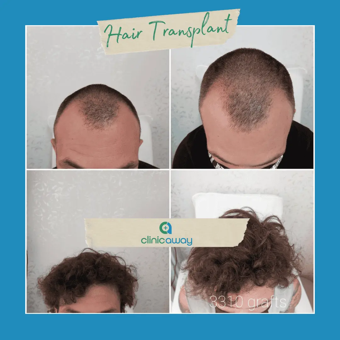 5-hair transplant.webp